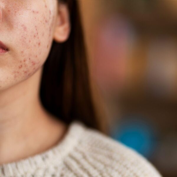 Meta Description:  Learn the different types of acne, their causes, and effective treatments. Learn how to manage acne with expert tips and regain healthy, clear.