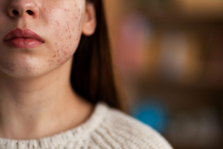 Meta Description:  Learn the different types of acne, their causes, and effective treatments. Learn how to manage acne with expert tips and regain healthy, clear.