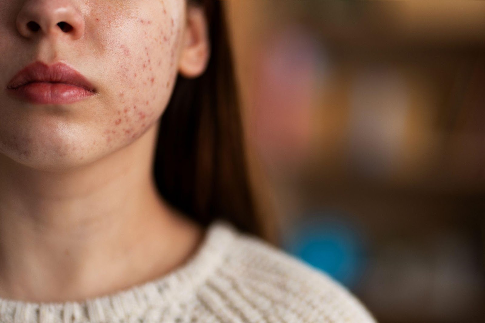 Meta Description:  Learn the different types of acne, their causes, and effective treatments. Learn how to manage acne with expert tips and regain healthy, clear.