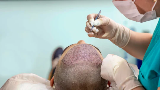 What You Should Know About Hair Transplants: A Comprehensive Guide