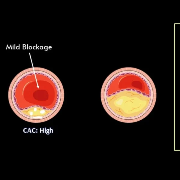 The Role of Calcium Heart Score in Predicting Heart Disease