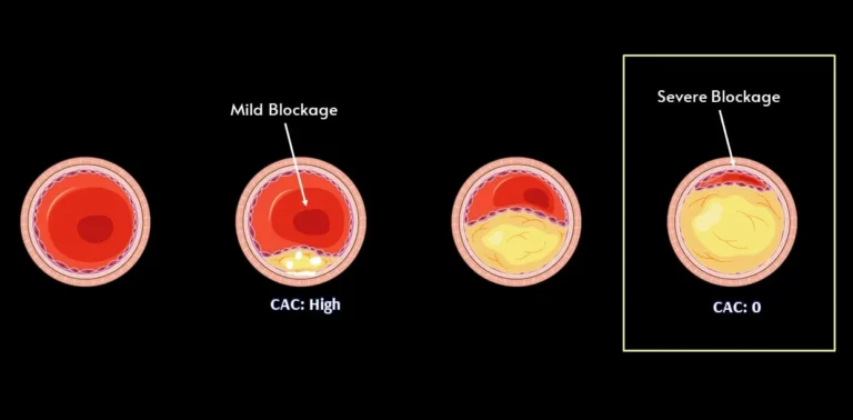 The Role of Calcium Heart Score in Predicting Heart Disease