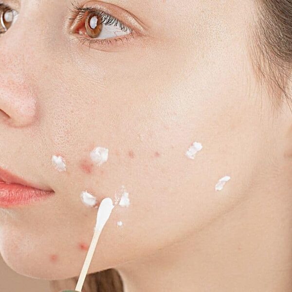 What Happens When You Overuse Acne Spot Treatment Gels?