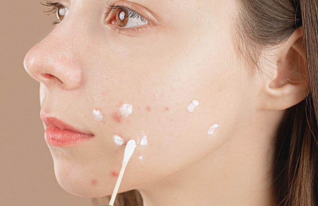 What Happens When You Overuse Acne Spot Treatment Gels?