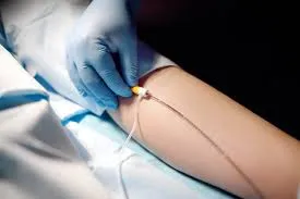 Modern Solutions For Varicose Veins: What To Expect From Vascular Surgery?