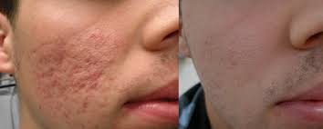 What Outcomes Are Expected from Medically Managed Scar Removal?